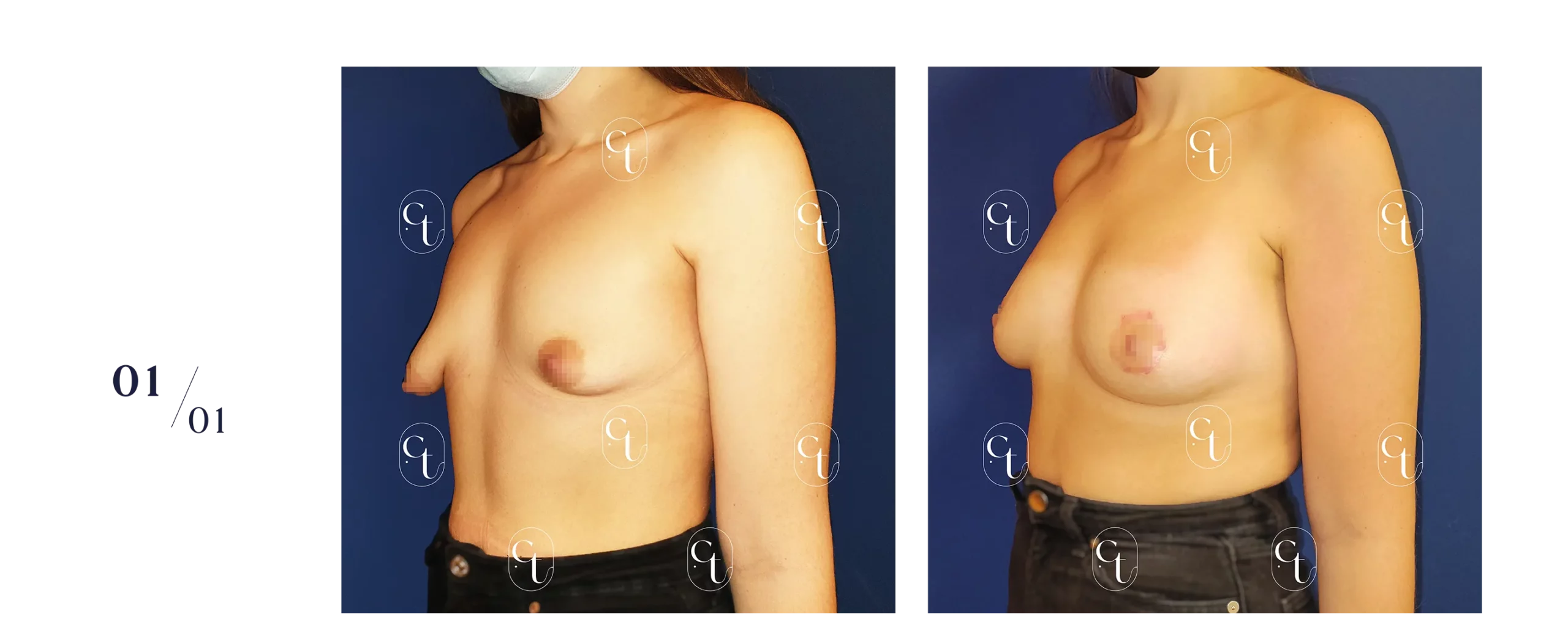 Patiente présentant des seins tubéreux asymétriques. La prise en charge se fait généralement en plusieurs étapes. Elle associe des gestes pour replacer les aréoles, et des séances de lipofilling afin de symétriser/augmenter le volume mammaire.