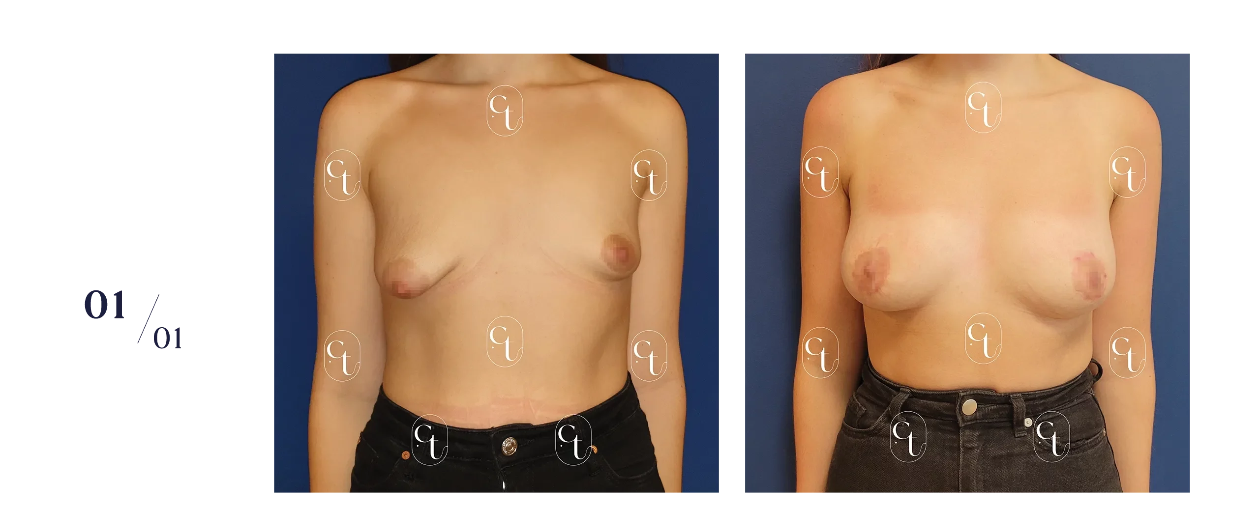 Patiente présentant des seins tubéreux asymétriques. La prise en charge associe un lifting mammaire ou mastopexie pour replacer les aréoles, et des séances de lipofilling afin de symétriser/augmenter le volume mammaire.