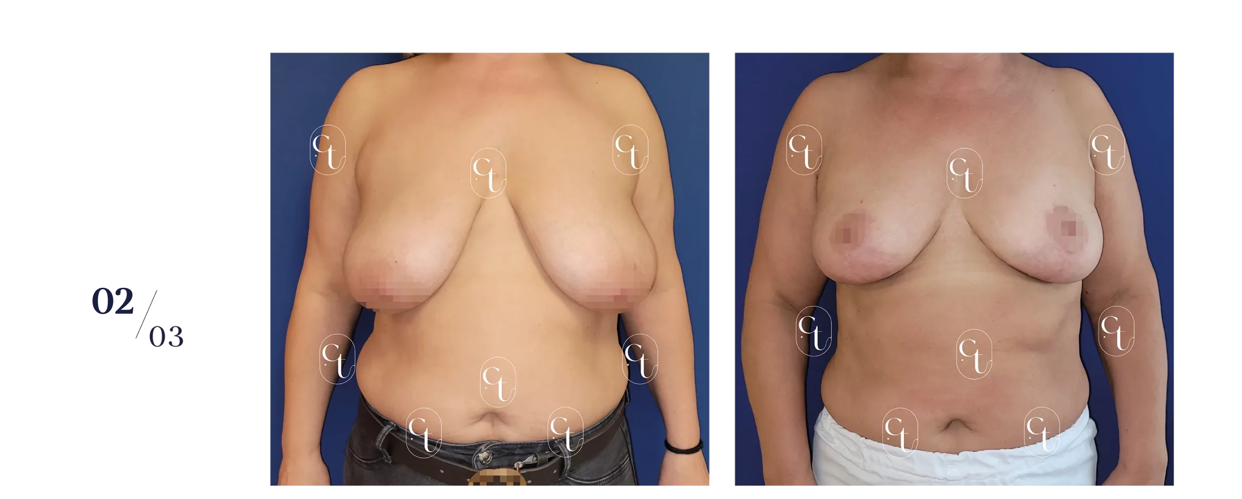 Résultat à 5 mois d'une réduction mammaire bilatérale. Plus de 300 grammes par sein ont été retirés : l'intervention est prise en charge en partie par l'Assurance Maladie.