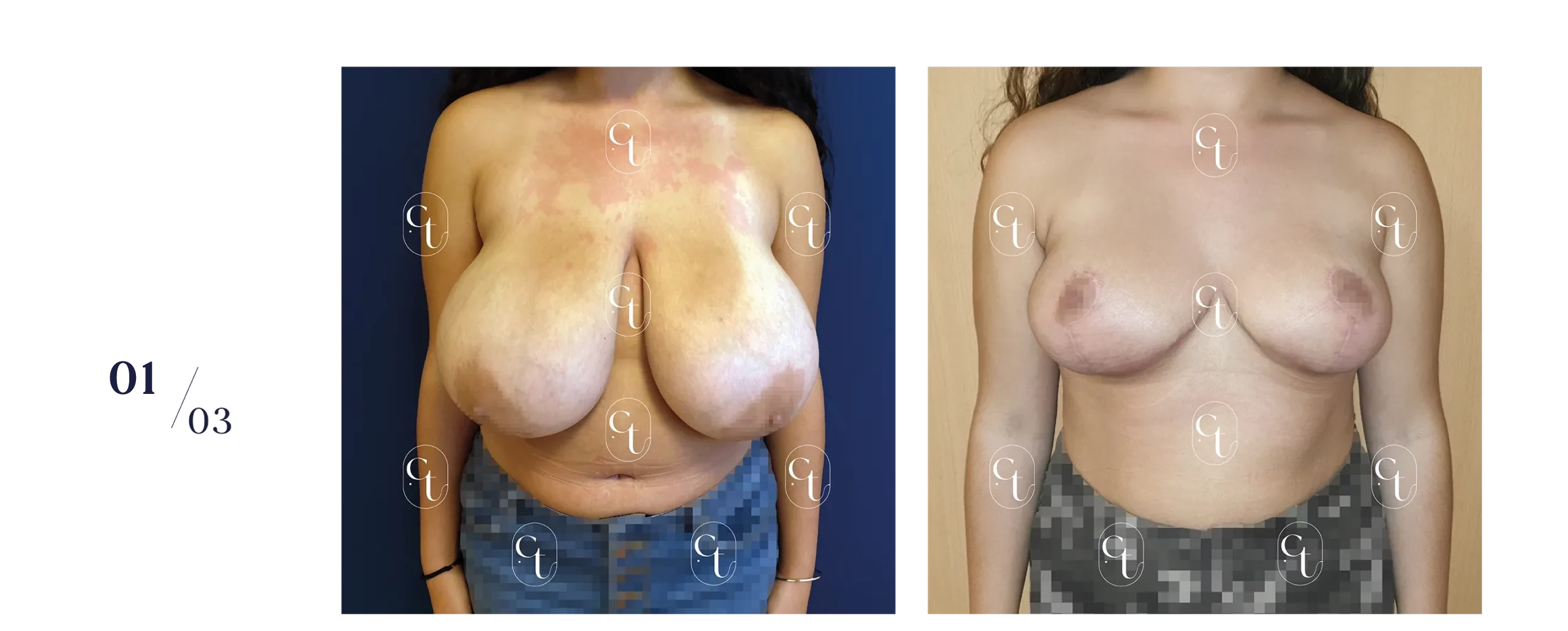 Résultat à 1,5 mois d'une réduction mammaire bilatérale chez une patiente de 16 ans. Plus de 300 grammes par sein ont été retirés : l'intervention est prise en charge par l'Assurance Maladie.