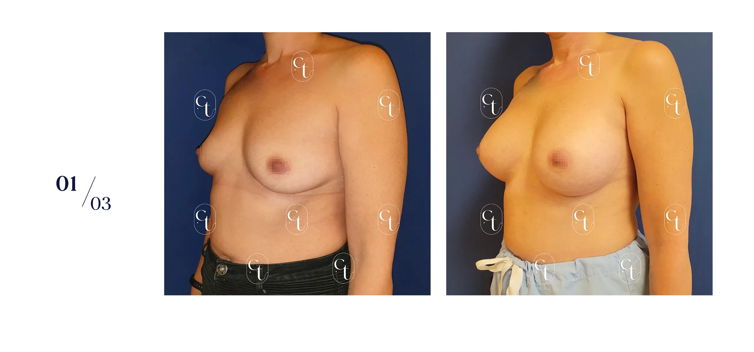 Résultat à 6 mois d'une augmentation mammaire par prothèses de 300mL de profil modéré, par voie sous-mammaire.